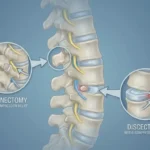 difference between laminectomy and discectomy